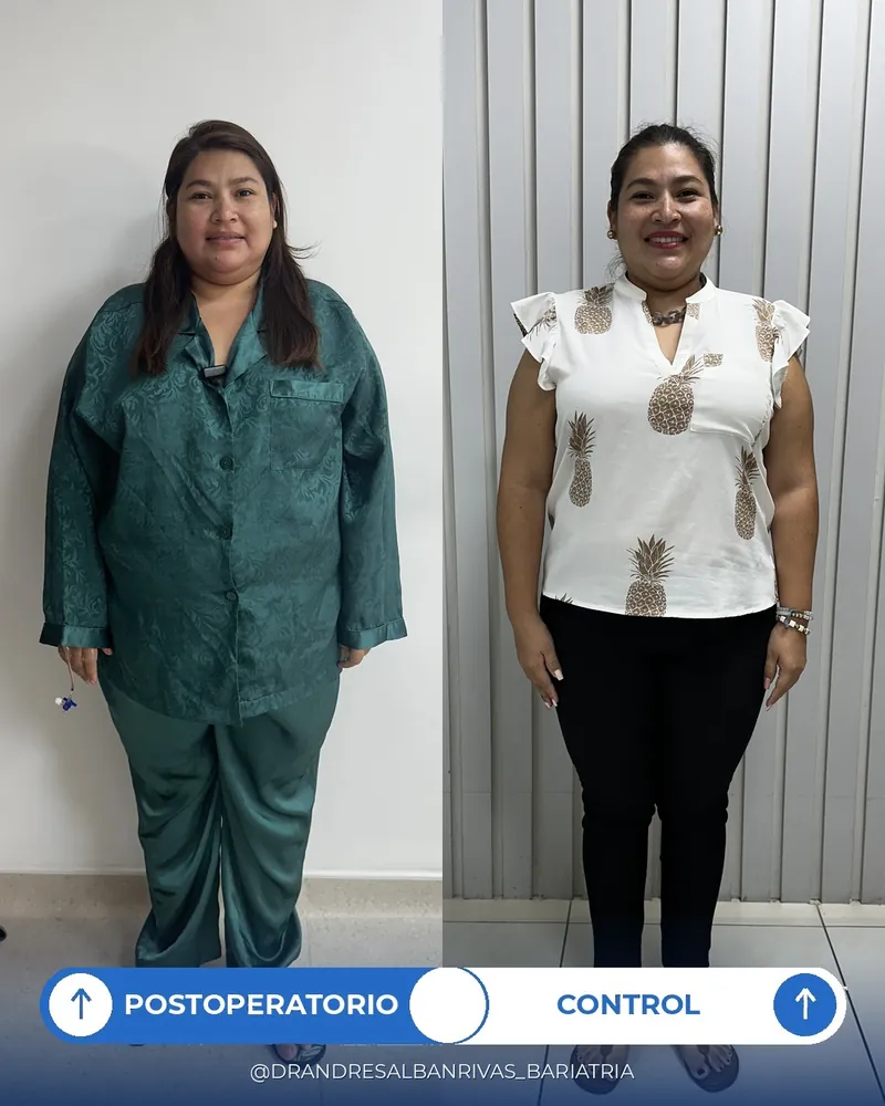 Antes y después de manga gástrica, paciente S. D.
