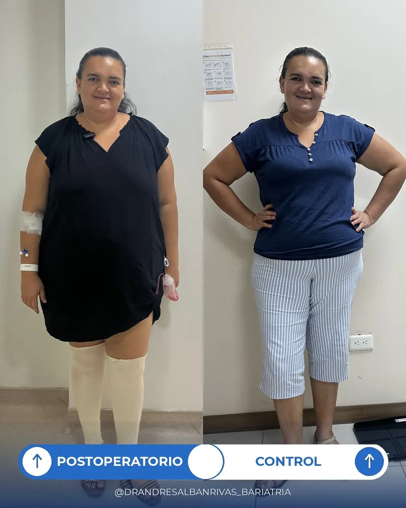 Antes y después de bypass gástrico, paciente M. A.