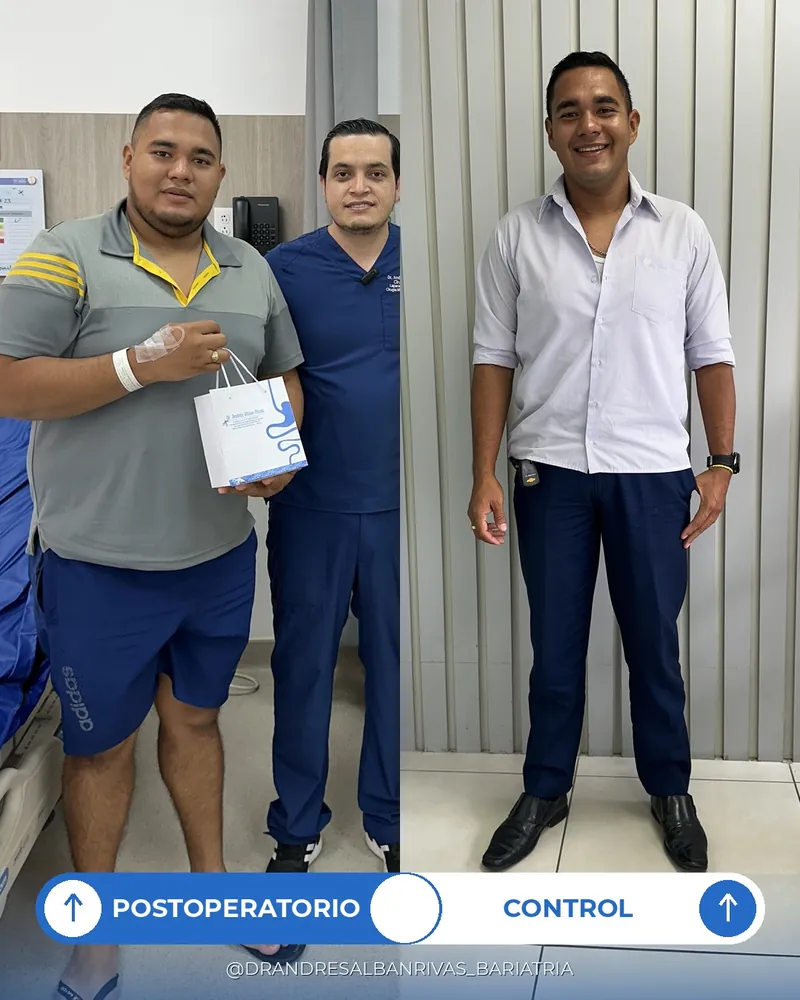 Antes y después de manga gástrica, paciente A. C.