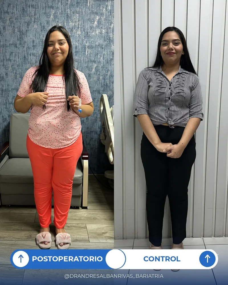 Antes y después de manga gástrica, paciente S. A.