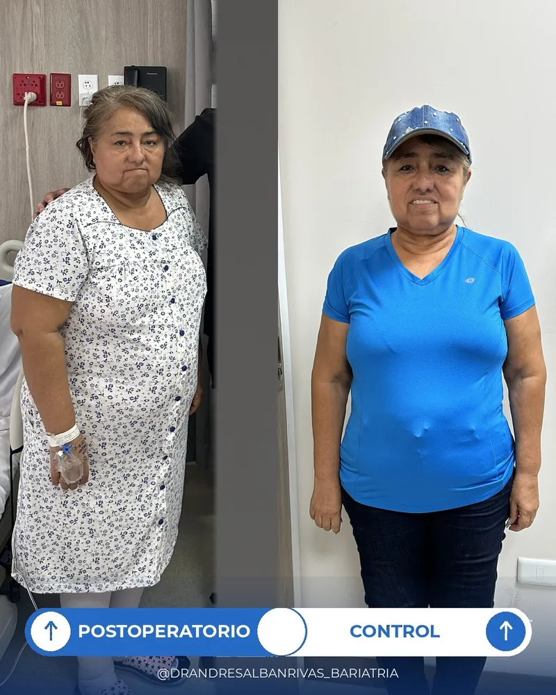 Antes y después de manga gástrica, paciente R. M.