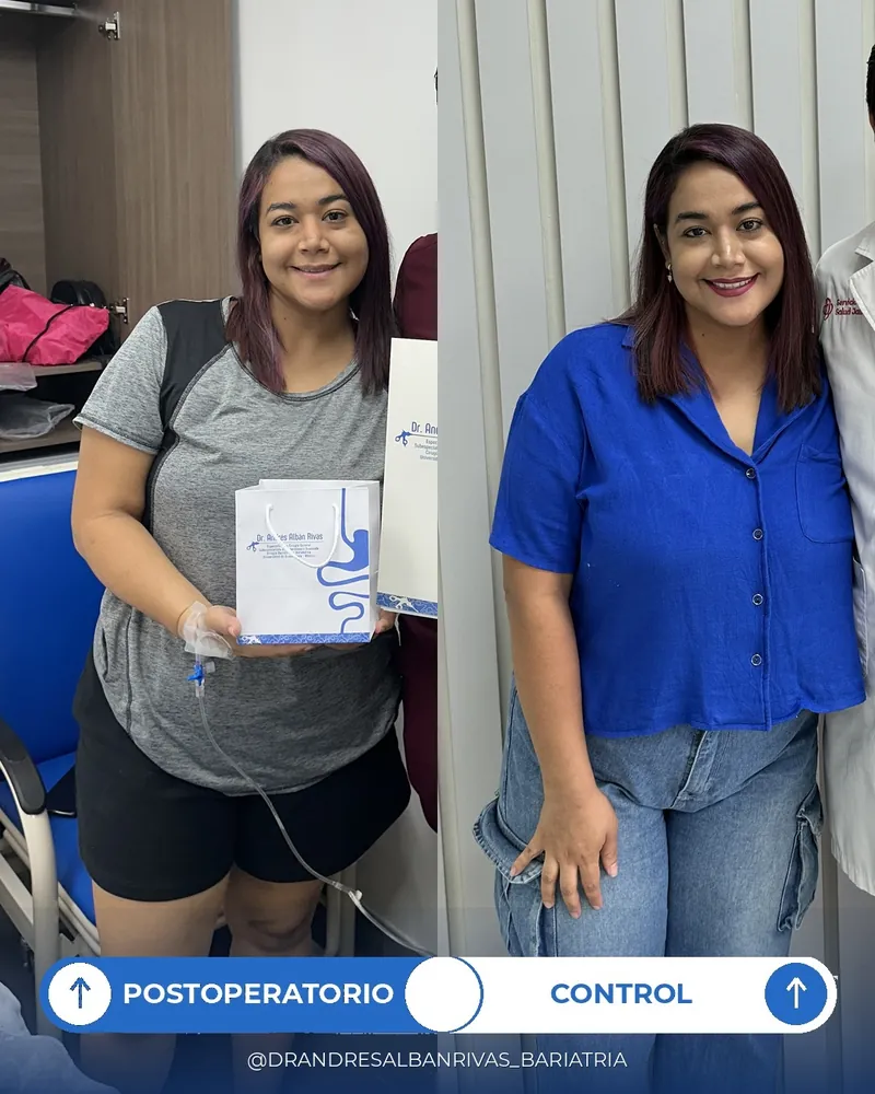 Antes y después de manga gástrica, paciente S. A.